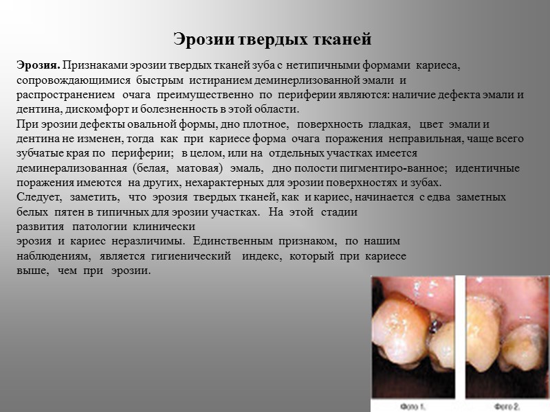 Эрозии твердых тканей Эрозия. Признаками эрозии твердых тканей зуба с нетипичными формами  кариеса,